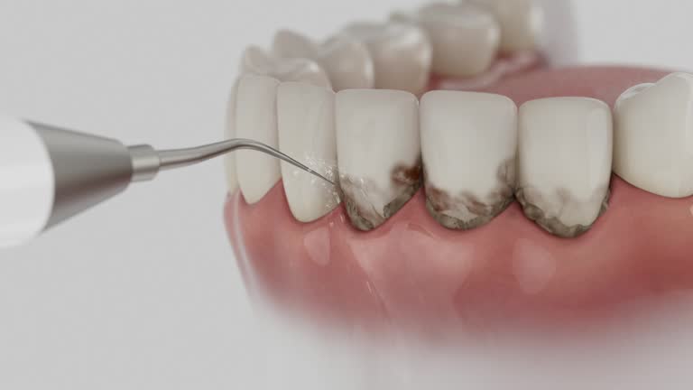 Trusted Wisdom Tooth Removal service in Hilmar-Irwin, CA - Dentist Open Now